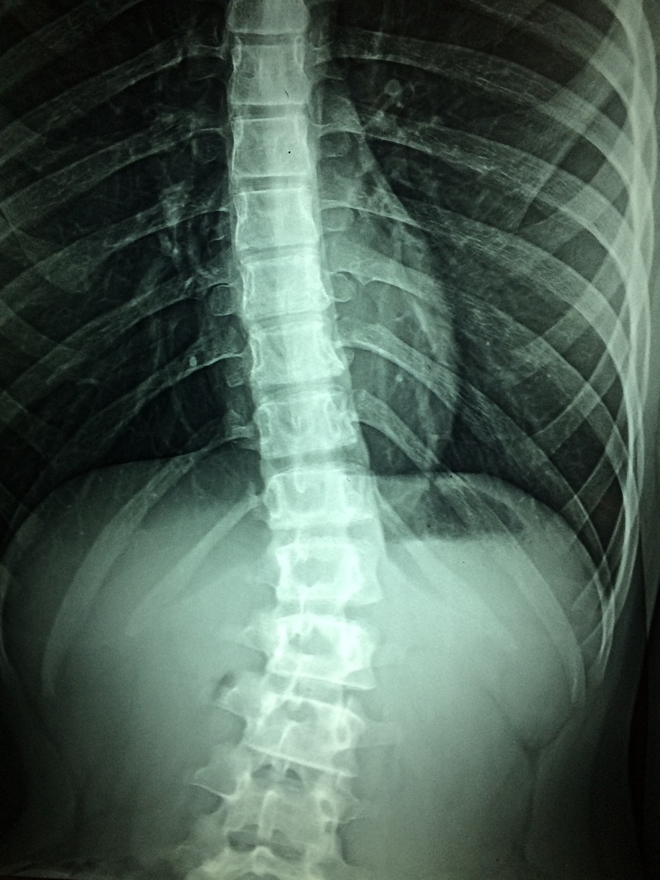 xray of the spine