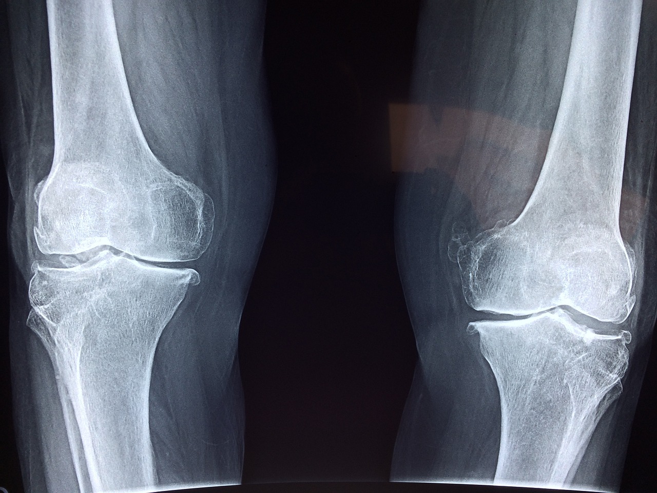 leg X-ray